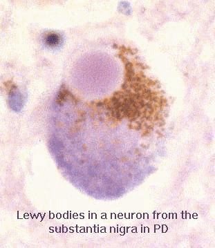 Lewy body in a neuron from the substantia nigra in Parkinson's disease. Aggregated alpha-synuclein protein