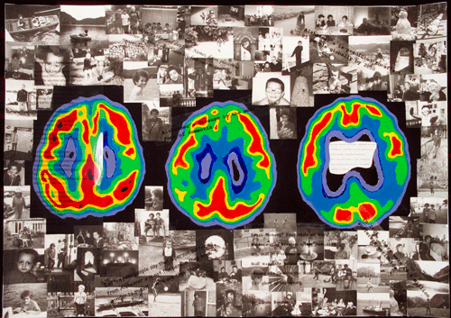 Artwork depicting; Neurodegeneration, Alzheimer's