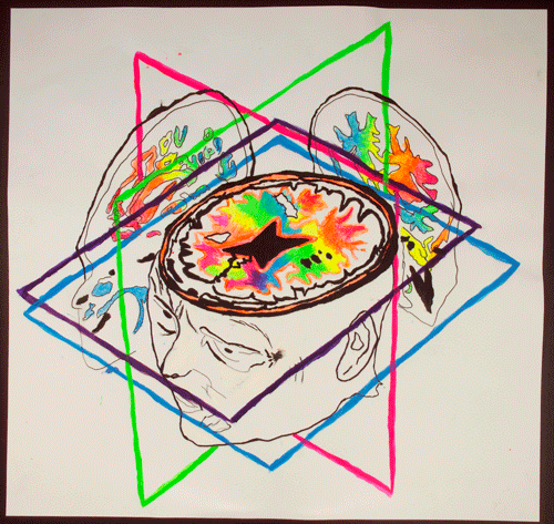 Artwork depicting; Neurodegeneration, Brain Scan