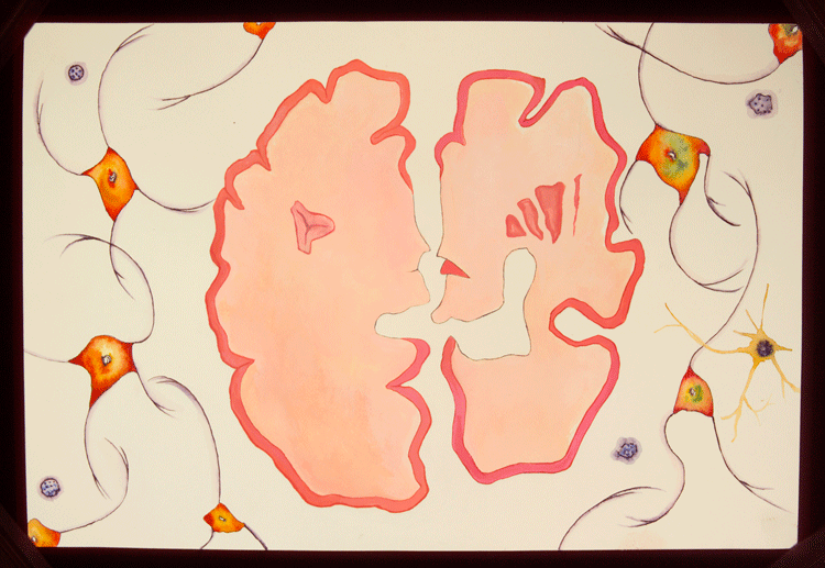 Artwork depicting; Parkinson's, Alzheimer's, Neurodegeneration