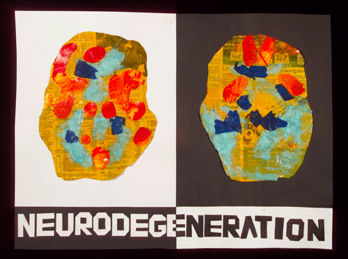 Artwork depicting; Neurodegeneration
