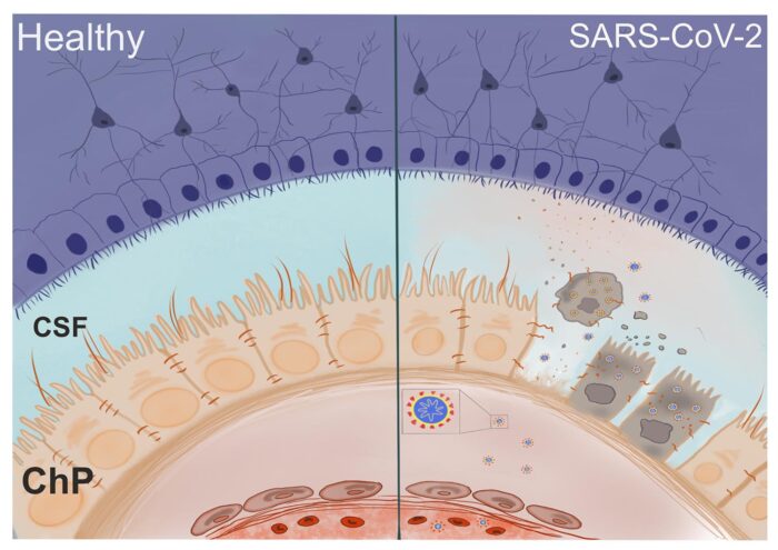 SARS-CoV-2 infects the choroid plexus damaging the blood-CSF barrier
