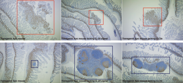 Images depicting sections of the intestine of the transgenic APC mouse model used in this study. Examples of intestine from a transgenic APC mouse (left), an APC mouse that lacks IL-25 (middle), and an APC mouse that lacks ILC2s (right). Individual dots indicate the nuclei of different cells. Brown nuclei indicate those cells (immune cells, epithelial cells or cancerous cells) that are actively proliferating. Nuclei of cells not proliferating are observed in blue.
Images on the upper row depict examples of intestinal cancerous tissue (red squares). It can be observed that the cancers from the transgenic APC mouse (left) are larger than those found in the APC mice that lack IL-25 (middle) or ILC2s (right).
Images on the lower row show lymphoid tissue containing immune cells (blue squares) present in the intestine. The transgenic APC mouse presents reduced lymphoid tissue. In contrast, APC mice without an IL-25 signal or ILC2s develop larger lymphoid tissue with actively proliferating immune cells, indicating a more active immune response.
