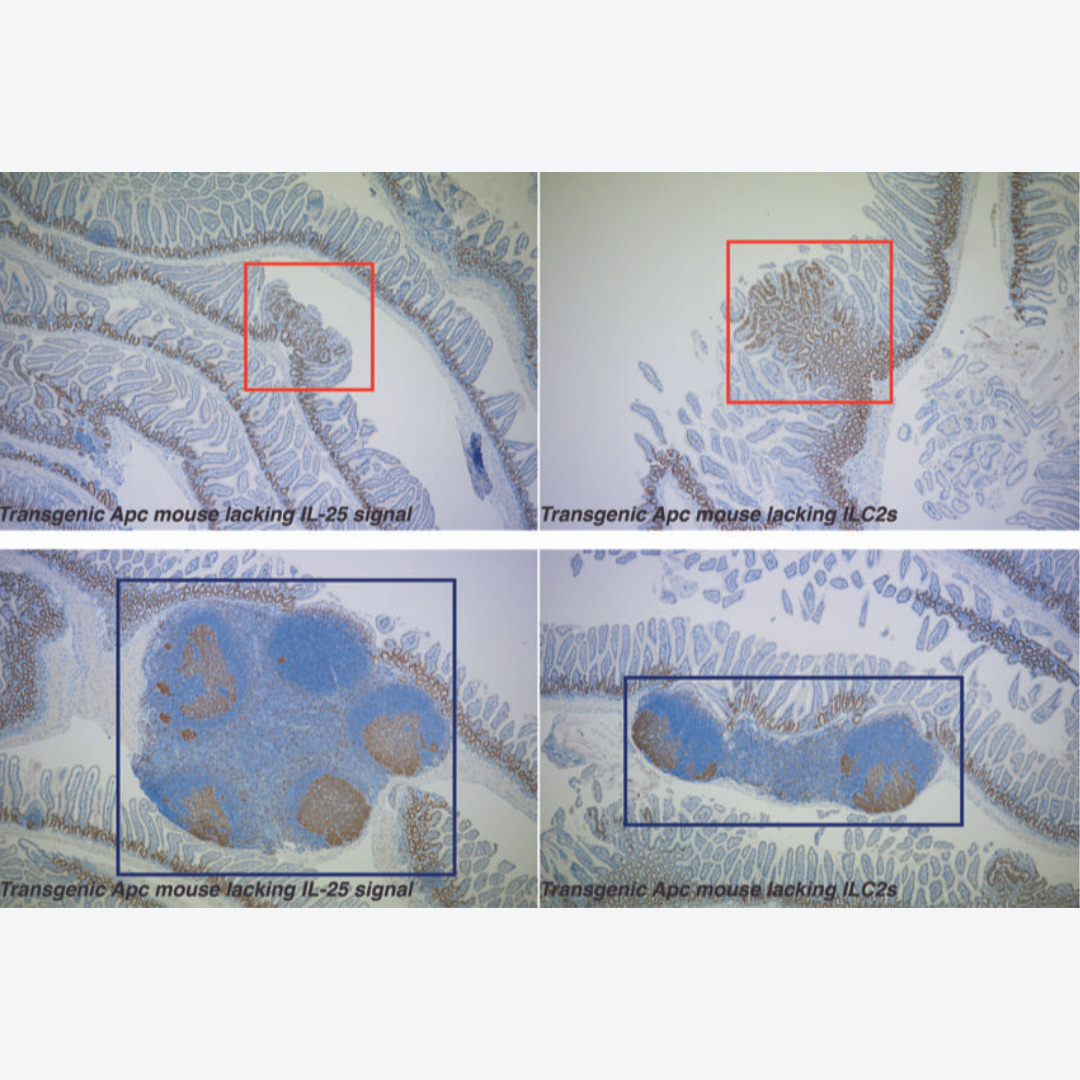 Blocking action of intestinal immune cell enhances the immune response to colorectal cancer - Vimarsana News