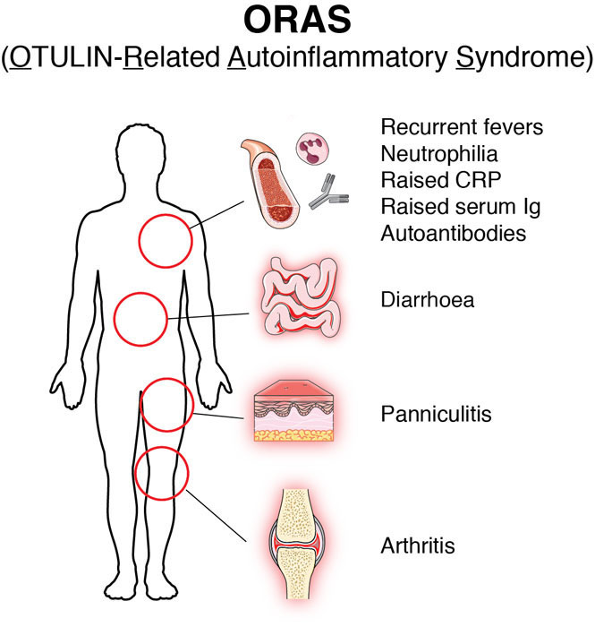 Major Breakthrough Identifies Cause And Treatment Of Fatal Autoimmune Disease Mrc Laboratory Of Molecular Biology