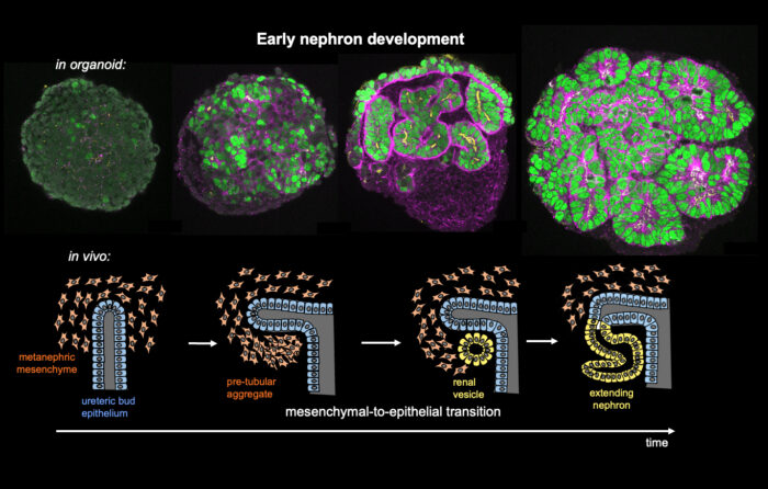Human renal organoids derived from induced pluripotent stem cells faithfully model early nephrogenesis in humans, especially the early polarization through a mesenchymal-to-epithelial transition and tube expansion. Renal organoids at successive stages are shown above a schematic representation of early nephrogenesis.